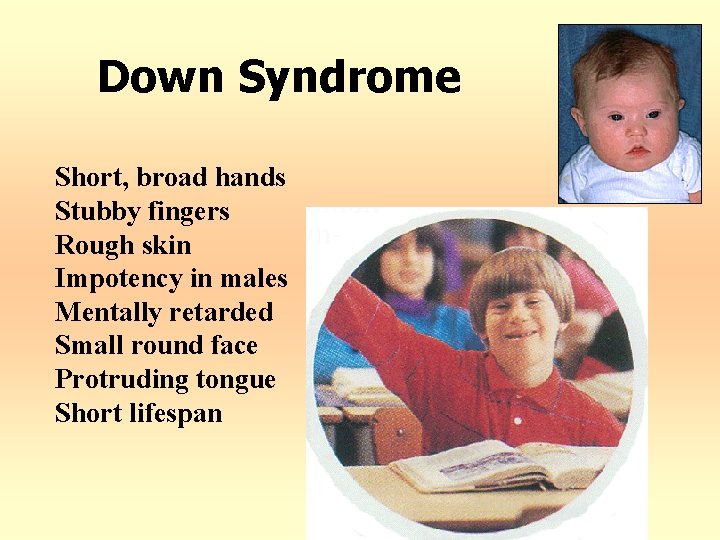 Down Syndrome Short, broad hands Stubby fingers Rough skin Impotency in males Mentally retarded