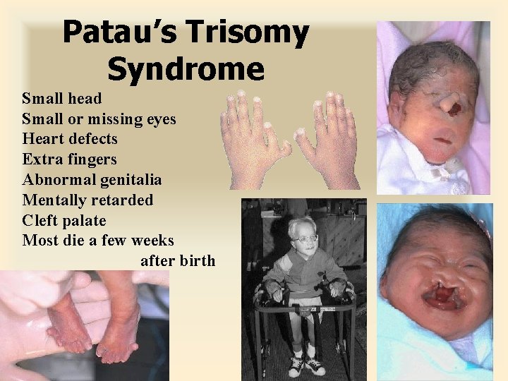 Patau’s Trisomy Syndrome Small head Small or missing eyes Heart defects Extra fingers Abnormal
