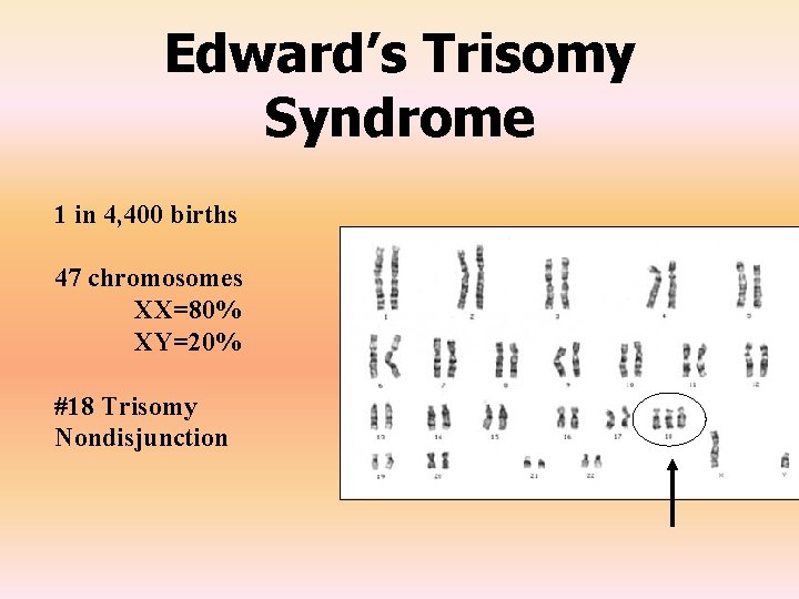 Edward’s Trisomy Syndrome 1 in 4, 400 births 47 chromosomes XX=80% XY=20% #18 Trisomy