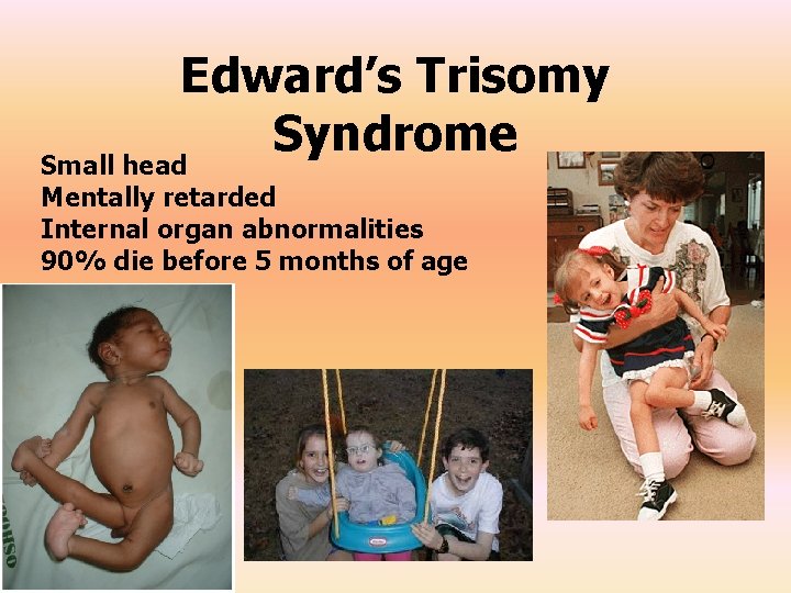Edward’s Trisomy Syndrome Small head Mentally retarded Internal organ abnormalities 90% die before 5