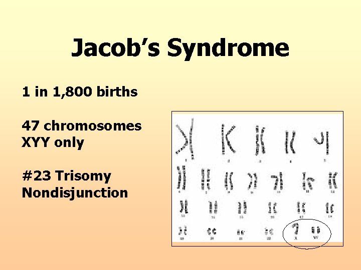 Jacob’s Syndrome 1 in 1, 800 births 47 chromosomes XYY only #23 Trisomy Nondisjunction
