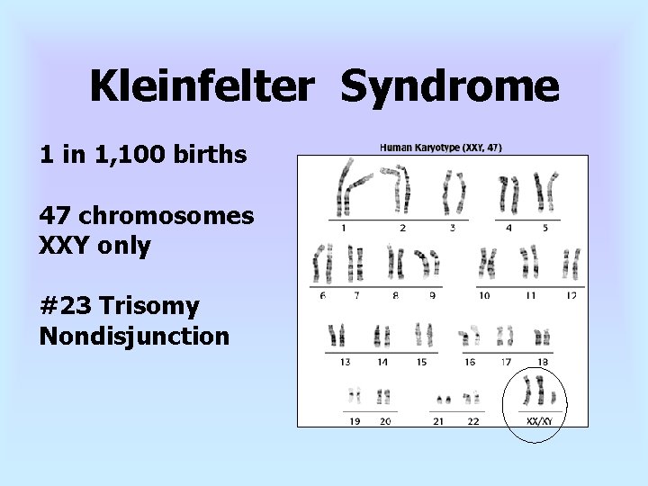 Kleinfelter Syndrome 1 in 1, 100 births 47 chromosomes XXY only #23 Trisomy Nondisjunction