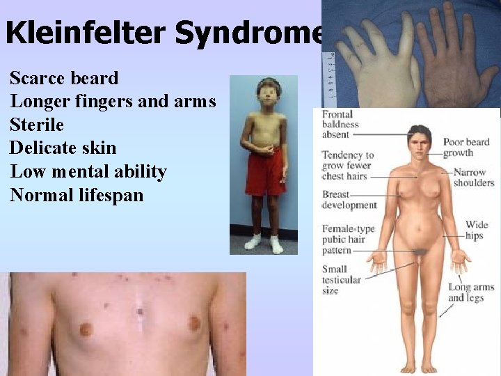 Kleinfelter Syndrome Scarce beard Longer fingers and arms Sterile Delicate skin Low mental ability