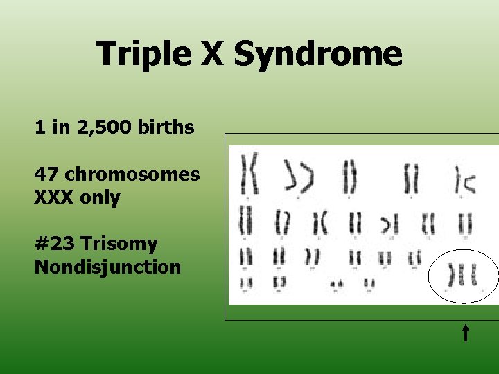 Triple X Syndrome 1 in 2, 500 births 47 chromosomes XXX only #23 Trisomy