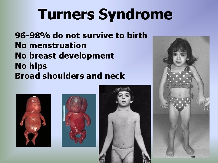 Turners Syndrome 96 -98% do not survive to birth No menstruation No breast development