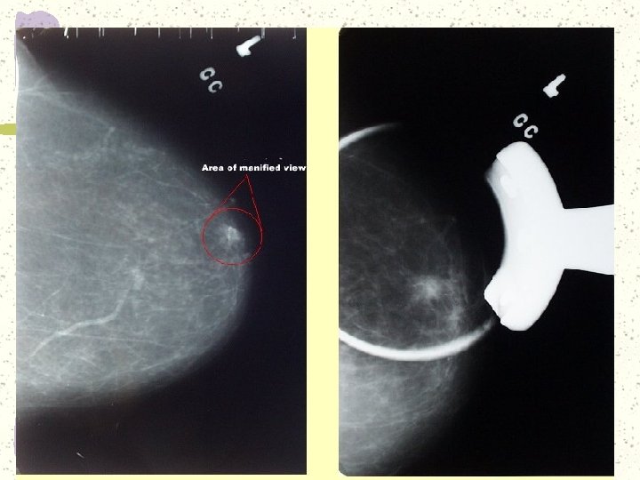 http: //sprojects. mmi. mcgill. ca/dir/mammography. html 
