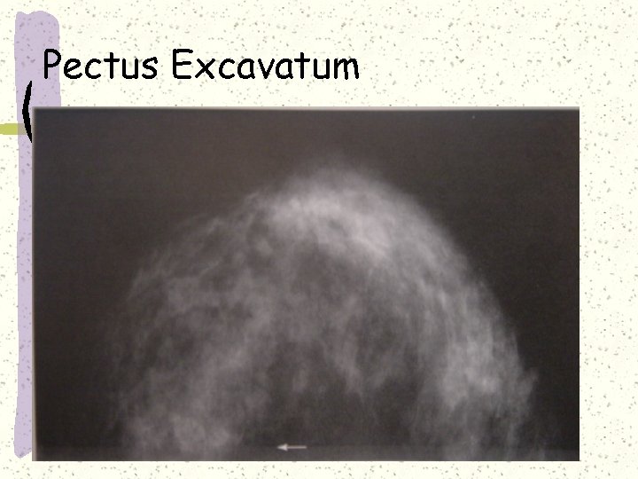 Pectus Excavatum 