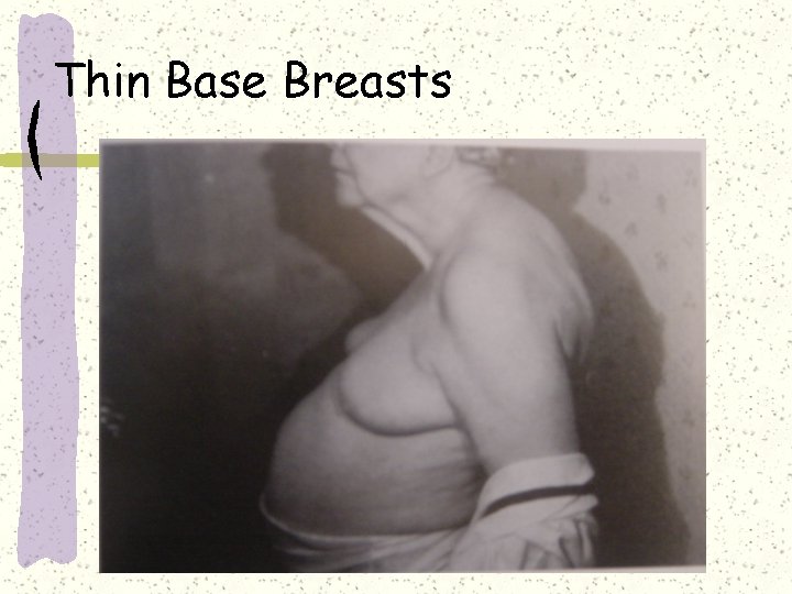 Thin Base Breasts 