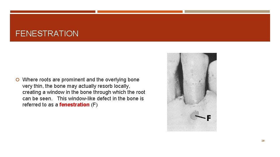 FENESTRATION Where roots are prominent and the overlying bone very thin, the bone may