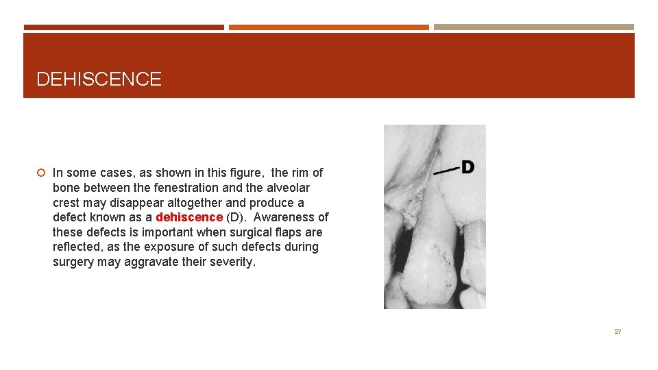 DEHISCENCE In some cases, as shown in this figure, the rim of bone between