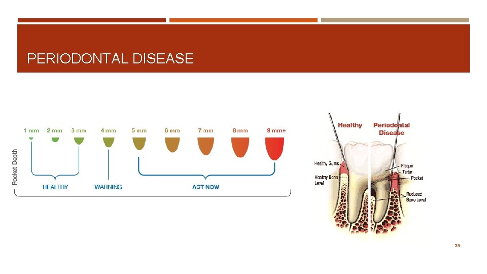 PERIODONTAL DISEASE 35 