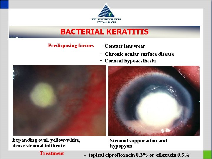 YEDİTEPE ÜNİVERSİTESİ GÖZ HASTANESİ BACTERIAL KERATITIS Predisposing factors • Contact lens wear • Chronic