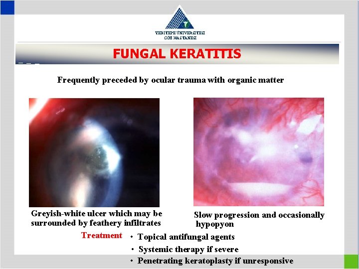 YEDİTEPE ÜNİVERSİTESİ GÖZ HASTANESİ FUNGAL KERATITIS Frequently preceded by ocular trauma with organic matter