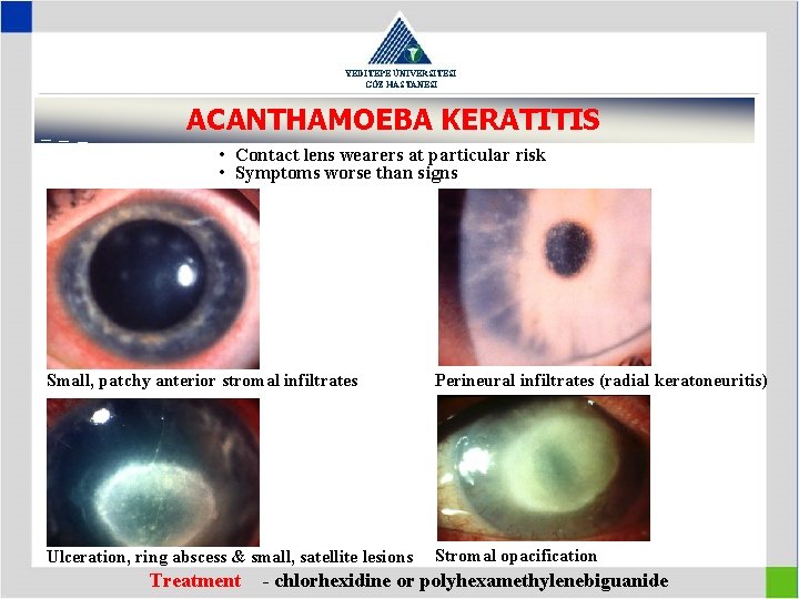 YEDİTEPE ÜNİVERSİTESİ GÖZ HASTANESİ ACANTHAMOEBA KERATITIS • Contact lens wearers at particular risk •