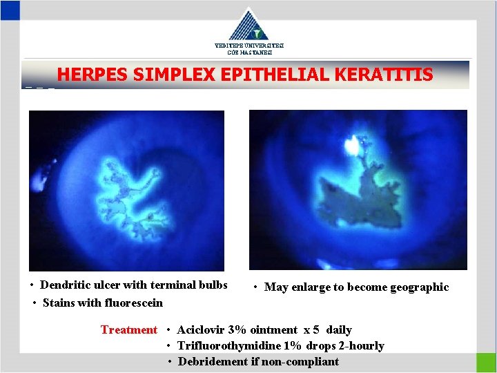 YEDİTEPE ÜNİVERSİTESİ GÖZ HASTANESİ HERPES SIMPLEX EPITHELIAL KERATITIS • Dendritic ulcer with terminal bulbs