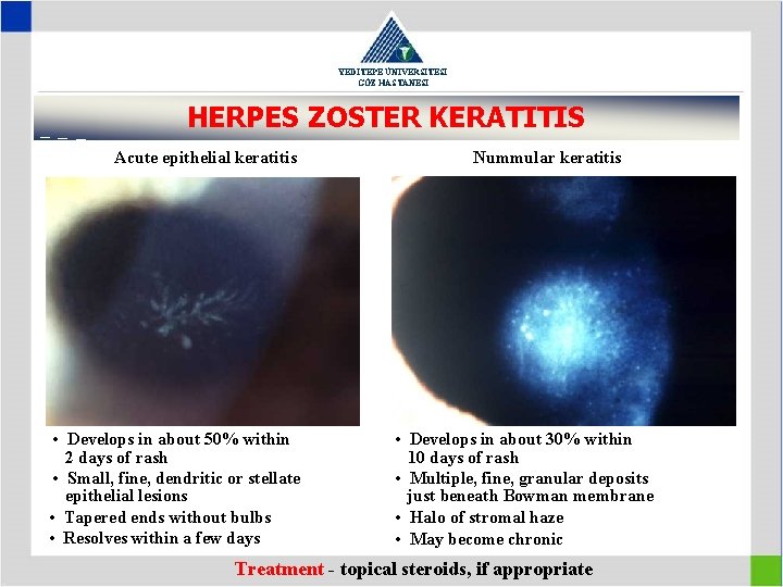 YEDİTEPE ÜNİVERSİTESİ GÖZ HASTANESİ HERPES ZOSTER KERATITIS Acute epithelial keratitis • Develops in about