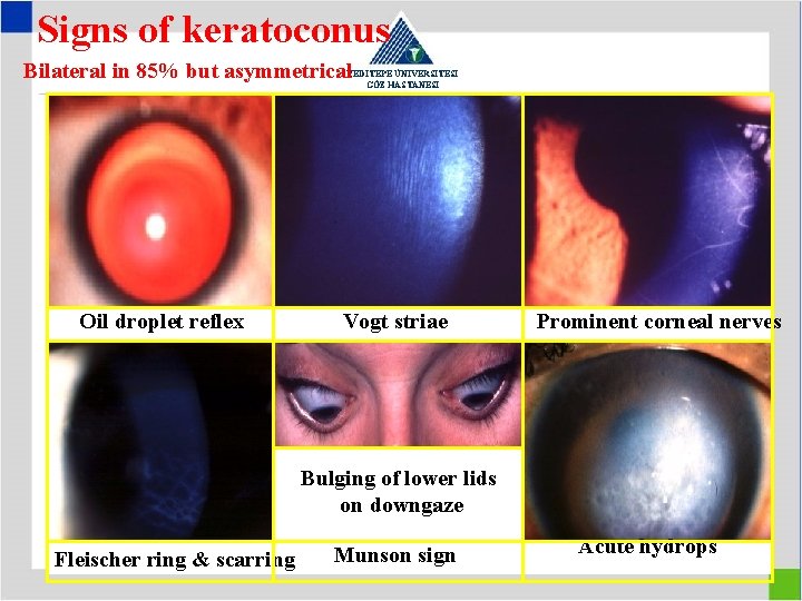 Signs of keratoconus Bilateral in 85% but asymmetrical YEDİTEPE ÜNİVERSİTESİ GÖZ HASTANESİ Oil droplet