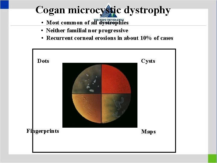 Cogan microcystic dystrophy YEDİTEPE ÜNİVERSİTESİ GÖZ HASTANESİ • Most common of all dystrophies •