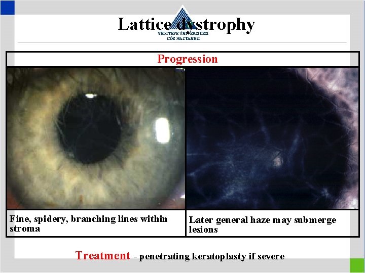 Lattice dystrophy YEDİTEPE ÜNİVERSİTESİ GÖZ HASTANESİ Progression Fine, spidery, branching lines within stroma Later