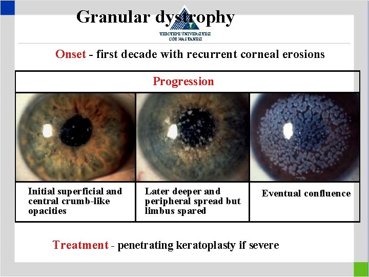 Granular dystrophy YEDİTEPE ÜNİVERSİTESİ GÖZ HASTANESİ Onset - first decade with recurrent corneal erosions