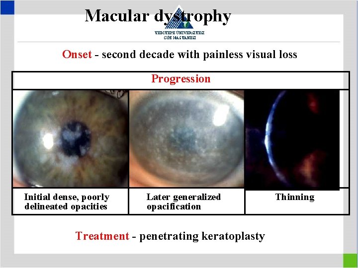 Macular dystrophy YEDİTEPE ÜNİVERSİTESİ GÖZ HASTANESİ Onset - second decade with painless visual loss