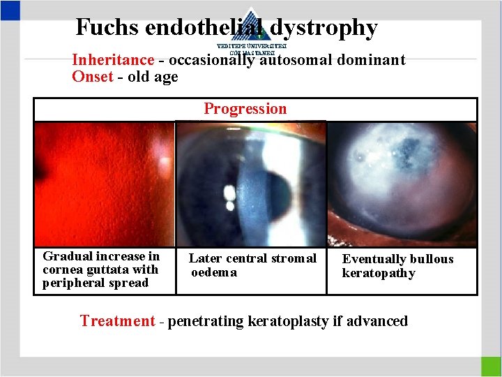 Fuchs endothelial dystrophy YEDİTEPE ÜNİVERSİTESİ GÖZ HASTANESİ Inheritance - occasionally autosomal dominant Onset -