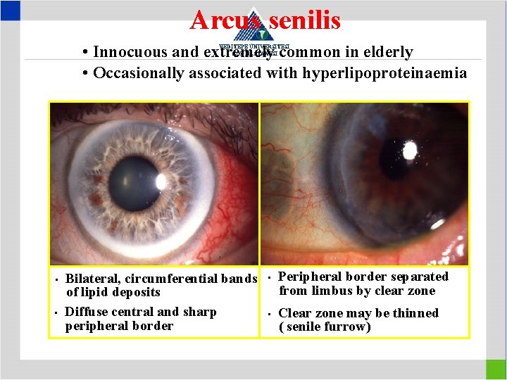 Arcus senilis • Innocuous and extremely common in elderly • Occasionally associated with hyperlipoproteinaemia