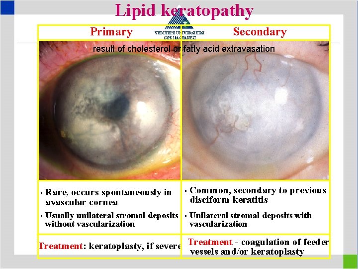 Lipid keratopathy Primary YEDİTEPE ÜNİVERSİTESİ GÖZ HASTANESİ Secondary result of cholesterol or fatty acid