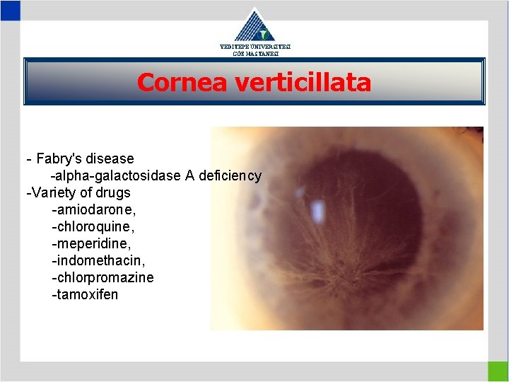 YEDİTEPE ÜNİVERSİTESİ GÖZ HASTANESİ Cornea verticillata - Fabry's disease -alpha-galactosidase A deficiency -Variety of