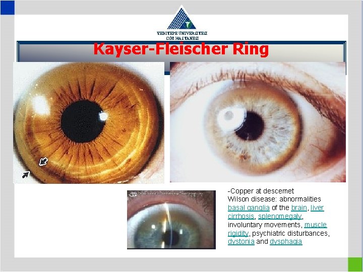 YEDİTEPE ÜNİVERSİTESİ GÖZ HASTANESİ Kayser-Fleischer Ring -Copper at descemet Wilson disease: abnormalities basal ganglia