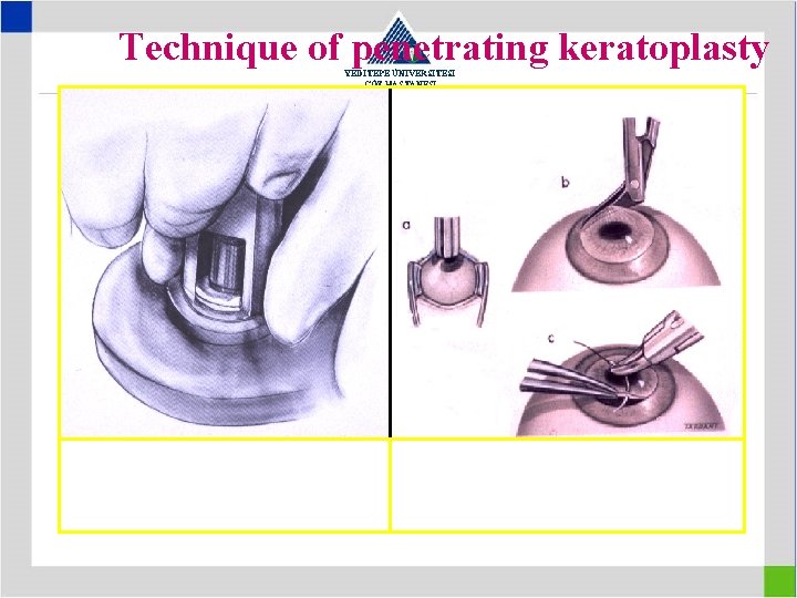 Technique of penetrating keratoplasty YEDİTEPE ÜNİVERSİTESİ GÖZ HASTANESİ Excision of donor tissue a, b