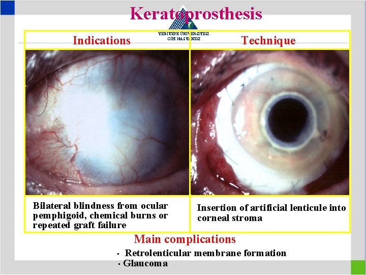 Keratoprosthesis Indications YEDİTEPE ÜNİVERSİTESİ GÖZ HASTANESİ Bilateral blindness from ocular pemphigoid, chemical burns or