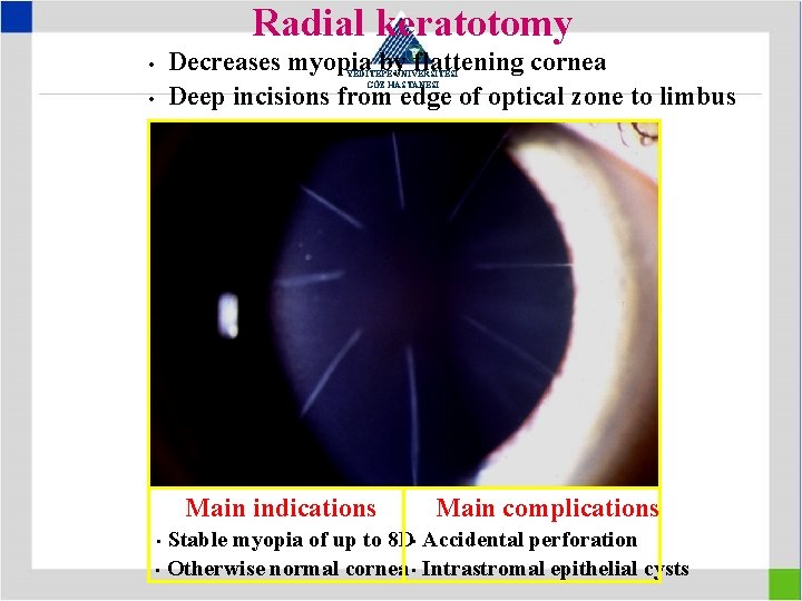 Radial keratotomy Decreases myopia by flattening cornea Deep incisions from edge of optical zone