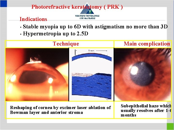 Photorefractive keratectomy ( PRK ) YEDİTEPE ÜNİVERSİTESİ GÖZ HASTANESİ Indications • Stable myopia up