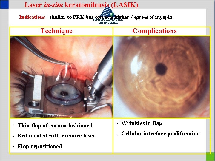 Laser in-situ keratomileusis (LASIK) Indications - similar to PRK but. YEDİTEPE corrects higher degrees