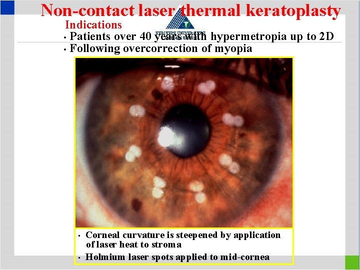 Non-contact laser thermal keratoplasty Indications • Patients over 40 years with hypermetropia up to