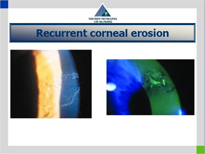 YEDİTEPE ÜNİVERSİTESİ GÖZ HASTANESİ Recurrent corneal erosion 