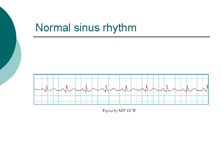Normal sinus rhythm 