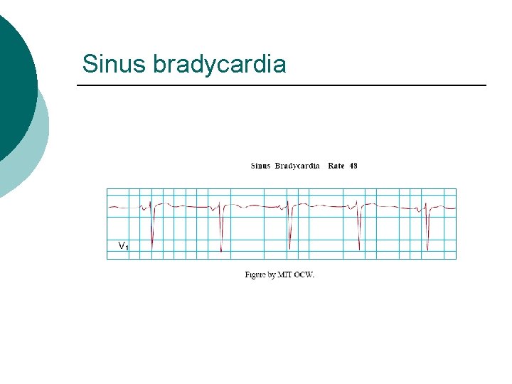 Sinus bradycardia 