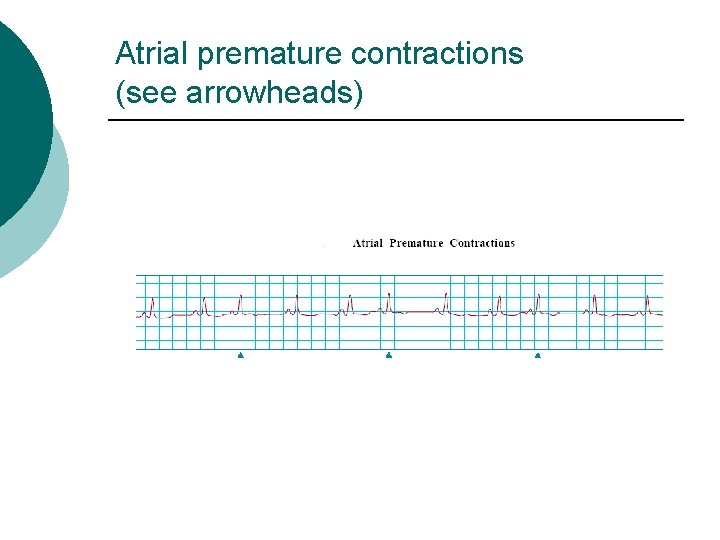 Atrial premature contractions (see arrowheads) 