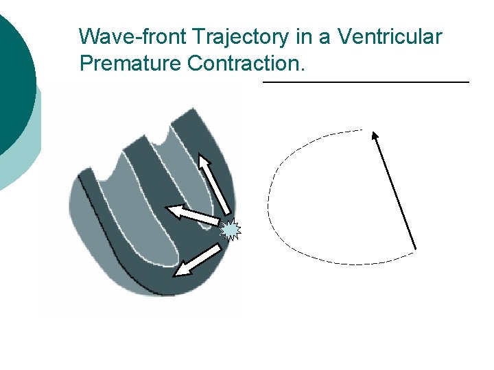 Wave-front Trajectory in a Ventricular Premature Contraction. 