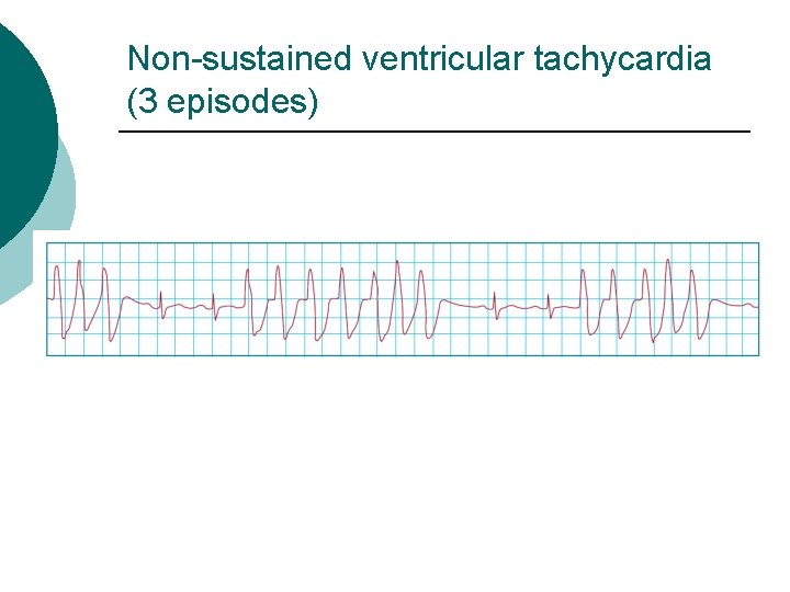 Non-sustained ventricular tachycardia (3 episodes) 