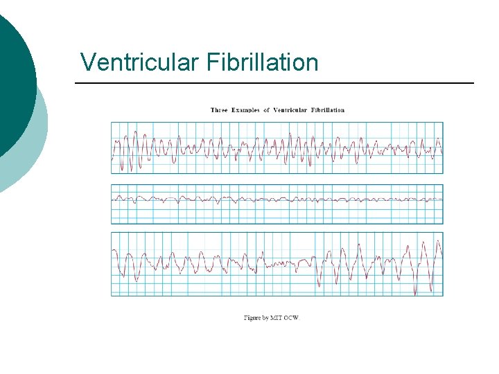 Ventricular Fibrillation 