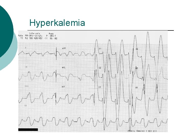 Hyperkalemia 