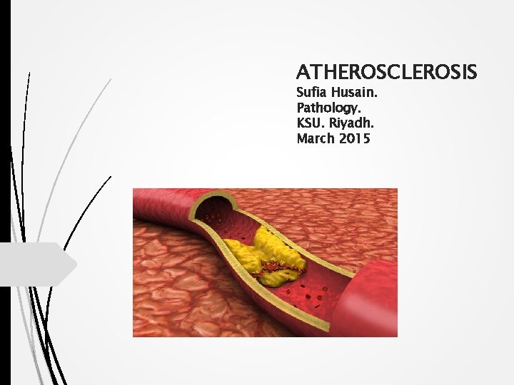 ATHEROSCLEROSIS Sufia Husain. Pathology. KSU. Riyadh. March 2015 
