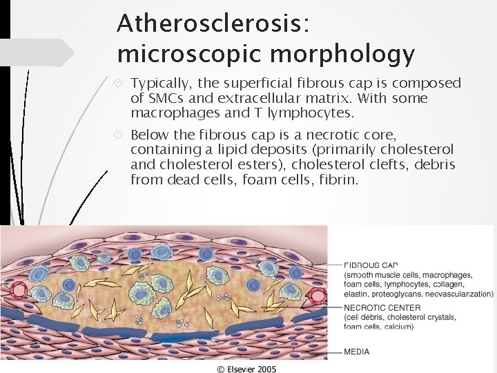 Atherosclerosis: microscopic morphology Typically, the superficial fibrous cap is composed of SMCs and extracellular
