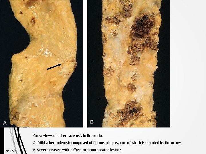 Gross views of atherosclerosis in the aorta. A. Mild atherosclerosis composed of fibrous plaques,