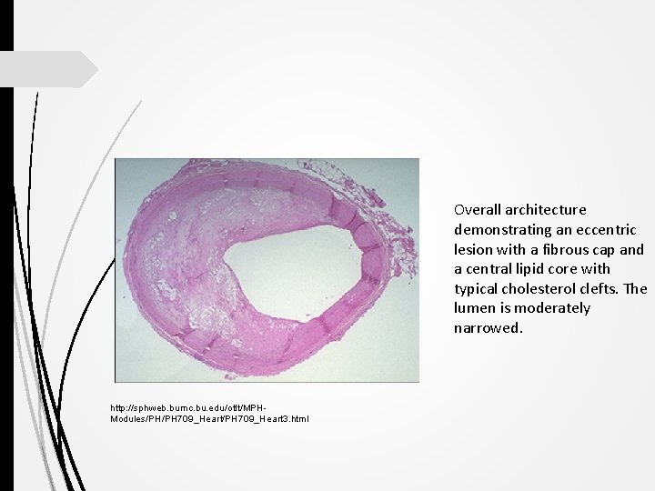 Overall architecture demonstrating an eccentric lesion with a fibrous cap and a central lipid
