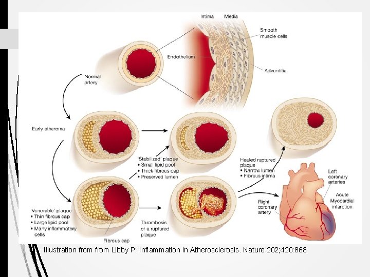 Illustration from Libby P: Inflammation in Atherosclerosis. Nature 202; 420: 868 