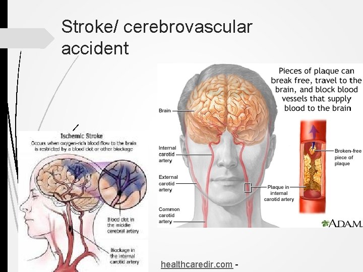 Stroke/ cerebrovascular accident healthcaredir. com - 